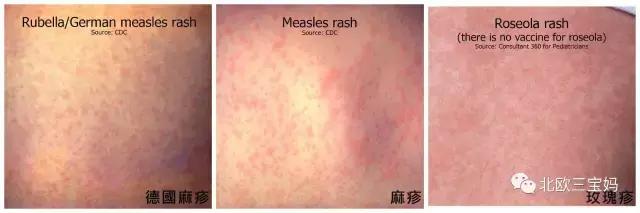 儿童急疹科普,宝宝湿疹和热疹的正确护理方法