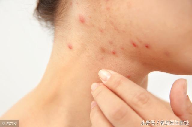 家里螨虫怎么治可以除根,家里螨虫怎么去除最有效