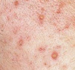 闭口痘痘推荐药膏,治疗粉刺闭口痘印药膏