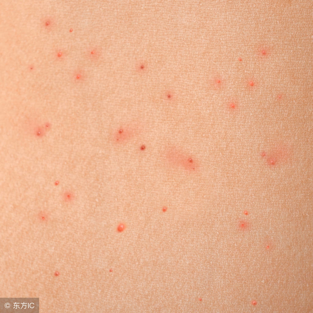 啥叫皮疹症状是啥样的,儿童嘴角红斑样皮疹