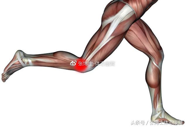 运动康复跑步膝盖疼,髂胫束摩擦综合征还能跑步吗