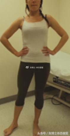 运动康复跑步膝盖疼,髂胫束摩擦综合征还能跑步吗