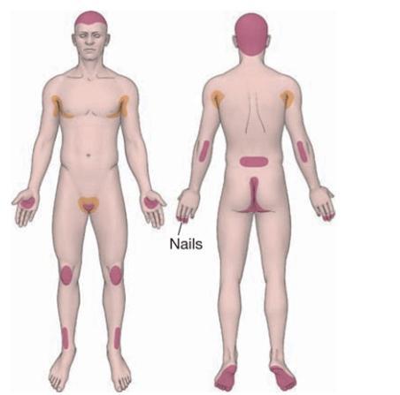 银屑病关节炎和银屑病区别,银屑病关节炎跟银屑病一样吗