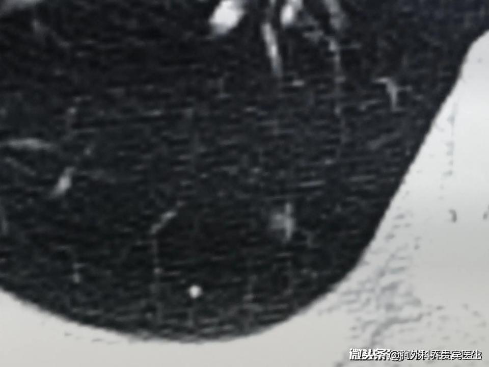 治疗肺部结节的中药方案有哪些,肺气肿肺部磨玻璃结节怎么治疗