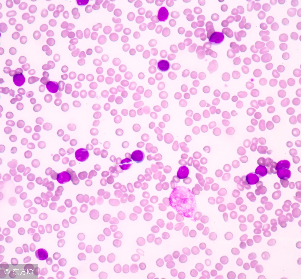 如何判断非霍奇金淋巴瘤治愈,怎么判断胃淋巴瘤严重程度