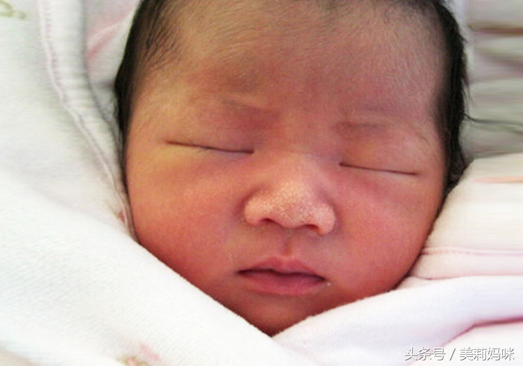 婴儿粟粒疹症状,婴儿粟粒疹越来越多怎么办