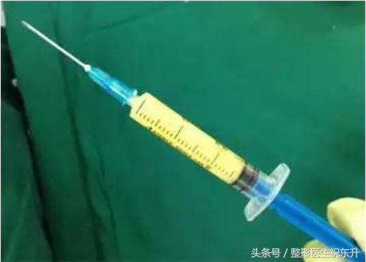 prp和自体脂肪哪个保持时间长点,prp填充和自体脂肪填充哪个好