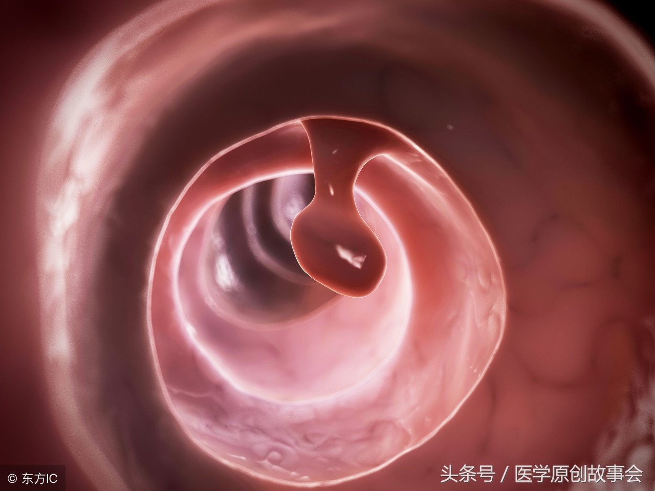 皮肤上这种痣十有八九是黑斑息肉，出现了一定要及时检查