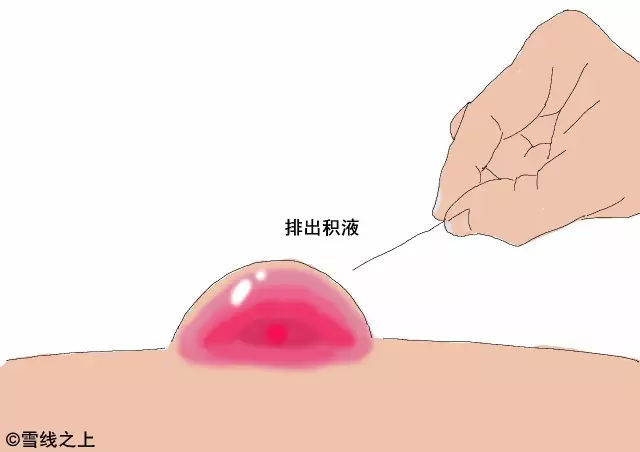 陶冶重庆｜徒步时，如何防治水泡？