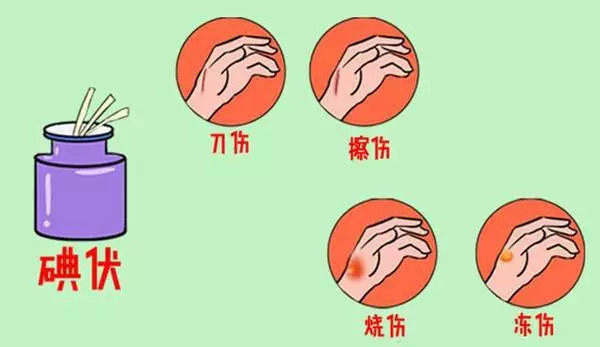 「科普」紫药水、红药水、酒精、碘伏……哪种处理伤口好？你可能一直都用错了