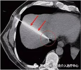 肝癌介入射频消融,肝癌微创消融手术