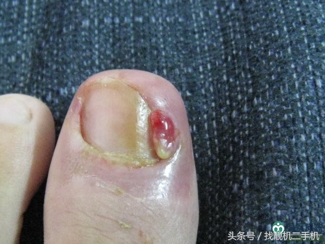 脚指甲长到肉里面，到底要怎么办？