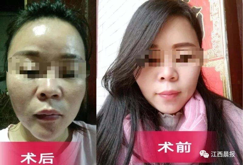 花6万整容,花6万整容认清现实