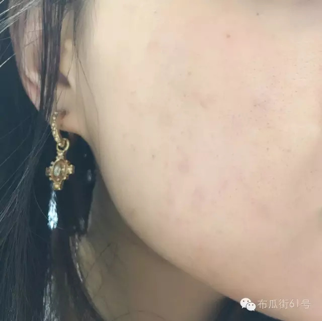 闭口痘痘怎么快速排出来,闭口痘痘身体上长怎么去除