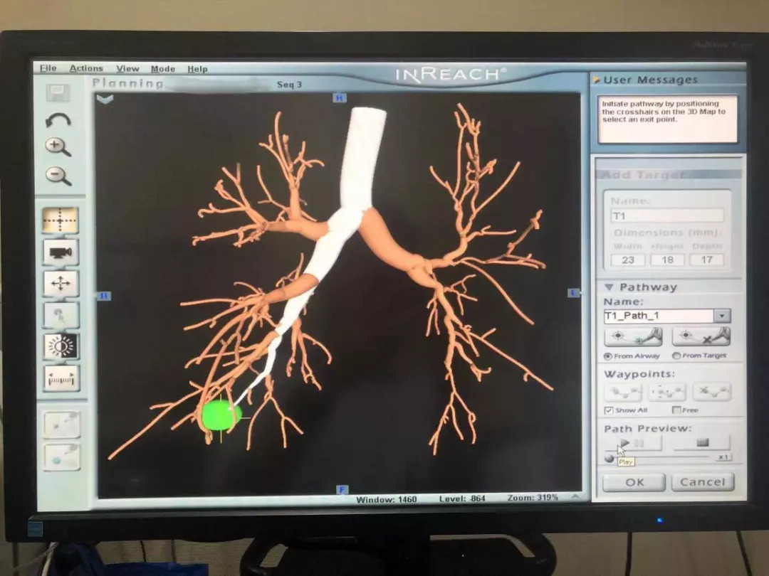 肺结节5mm背疼确诊肺癌,肺结节如何确诊为肺癌