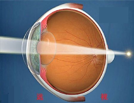 远眺有利于缓解散光吗,远眺对近视的好处