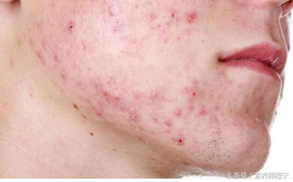 下巴两边腮帮子反复长痘痘怎么办,腮帮子两边反复起痘粉刺