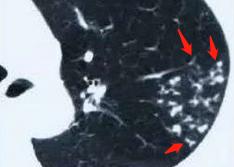 患结核的帅小哥很憋屈:4个月没牵女朋友的手,我现在还传染吗?