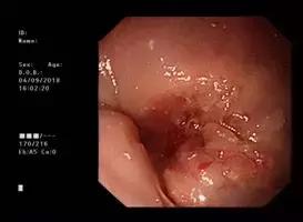 食管癌吞不下饭怎么办,食管肿瘤吃不下东西怎么减轻痛苦