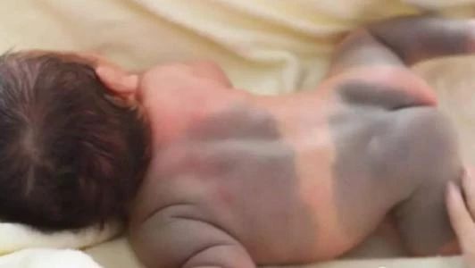 宝宝屁股上有青印,宝宝屁股上有划痕是什么情况