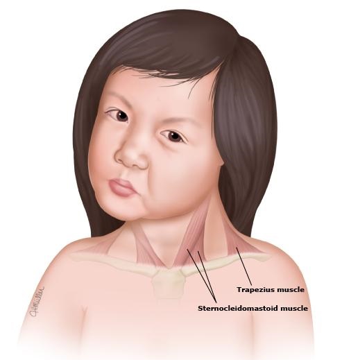 歪脖的症状图片,什么病能引起脖子歪