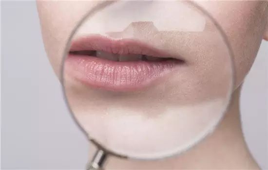 有唇纹怎么去除唇纹,修复唇纹淡化唇纹