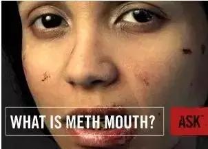 这一口烂牙，就能让你意识到*品毒**的破坏力有多恐怖