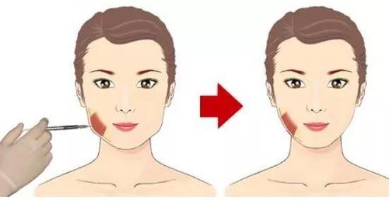 瘦脸针与溶脂针哪个更安全,瘦脸针安全吗脸大适合打瘦脸针吗