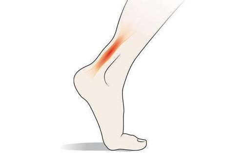 小腿前侧肌肉损伤多久可以好,运动时小腿肌肉损伤怎么治疗