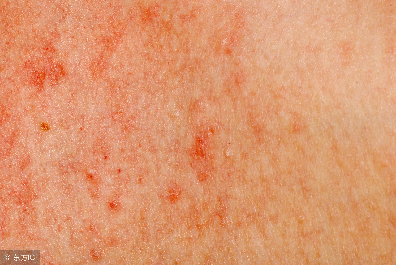 疱疹是空气传染还是飞沫传染,生殖器疱疹怎么预防传染