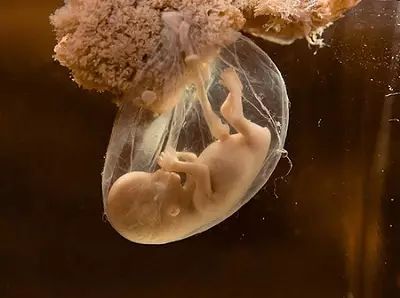 怀孕了羊水太多了怎么办,怀孕一般羊水多好还是少好