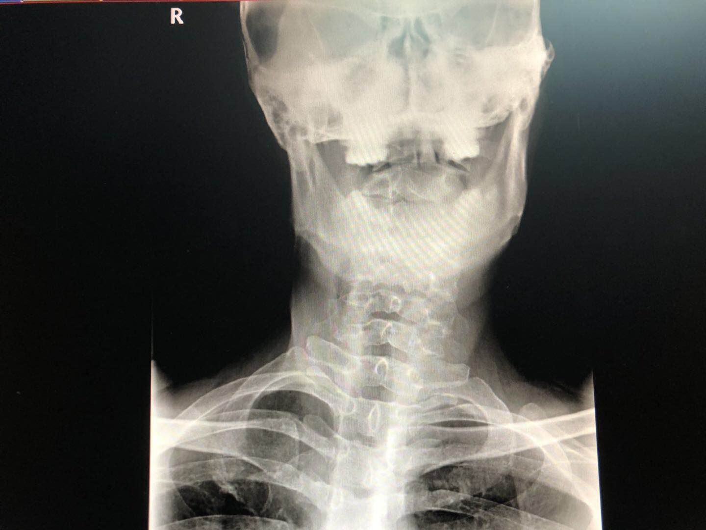歪脖怎么调理最有效,成年人脖子歪的最快治愈方法