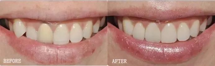 刷牙真的可以清除食物残渣吗,刷牙只能清除20%的口腔细菌