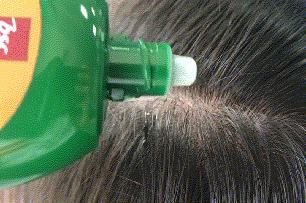 23岁脱发严重m型脱发怎么拯救,脱发斑秃脂溢性脱发