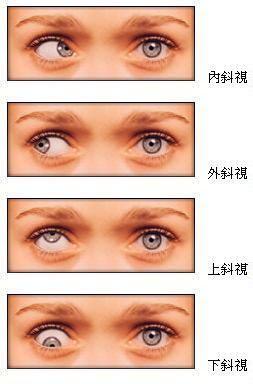 斗鸡眼如何预防和治疗,预防宝宝斜视斗鸡眼