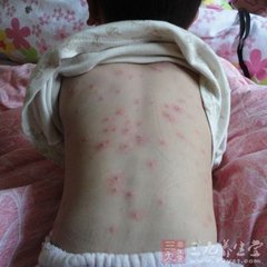 痘痘可以等它自然消失吗,痘痘消不掉有颗粒感