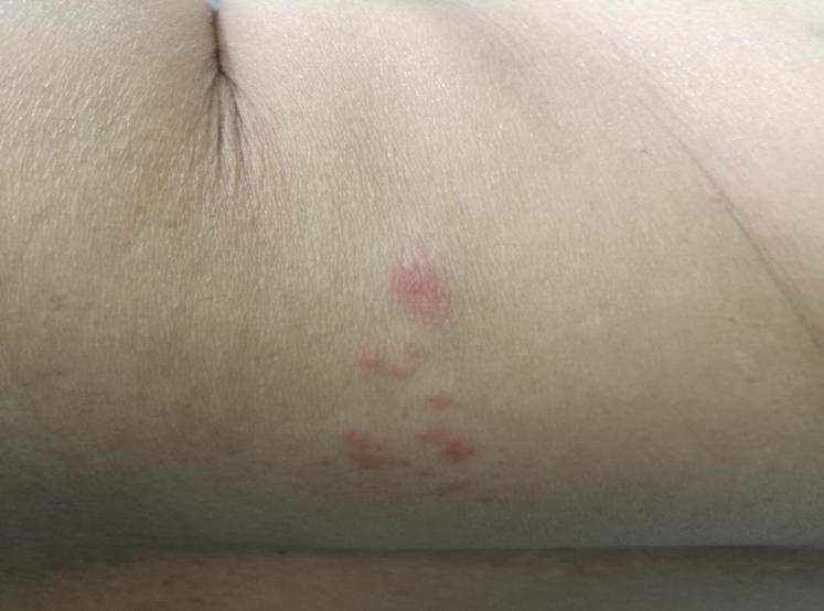 痘痘可以等它自然消失吗,痘痘消不掉有颗粒感