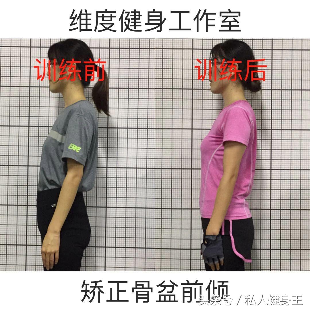 长期久坐骨盆前倾最快矫正法,如何改善久坐骨盆前倾