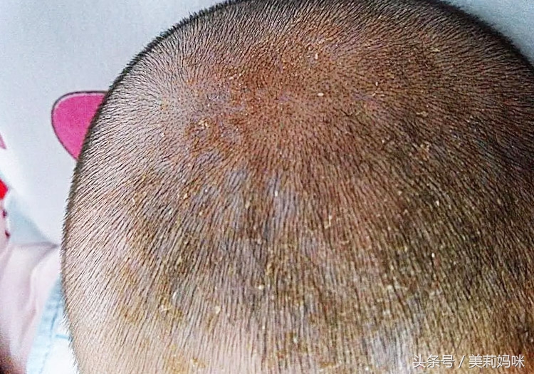 新生儿头上的乳痂要怎么处理,婴儿头上乳痂简单有效的清理方法