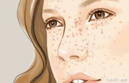 如何正确的减少雀斑,怎么快速有效的祛雀斑小妙招