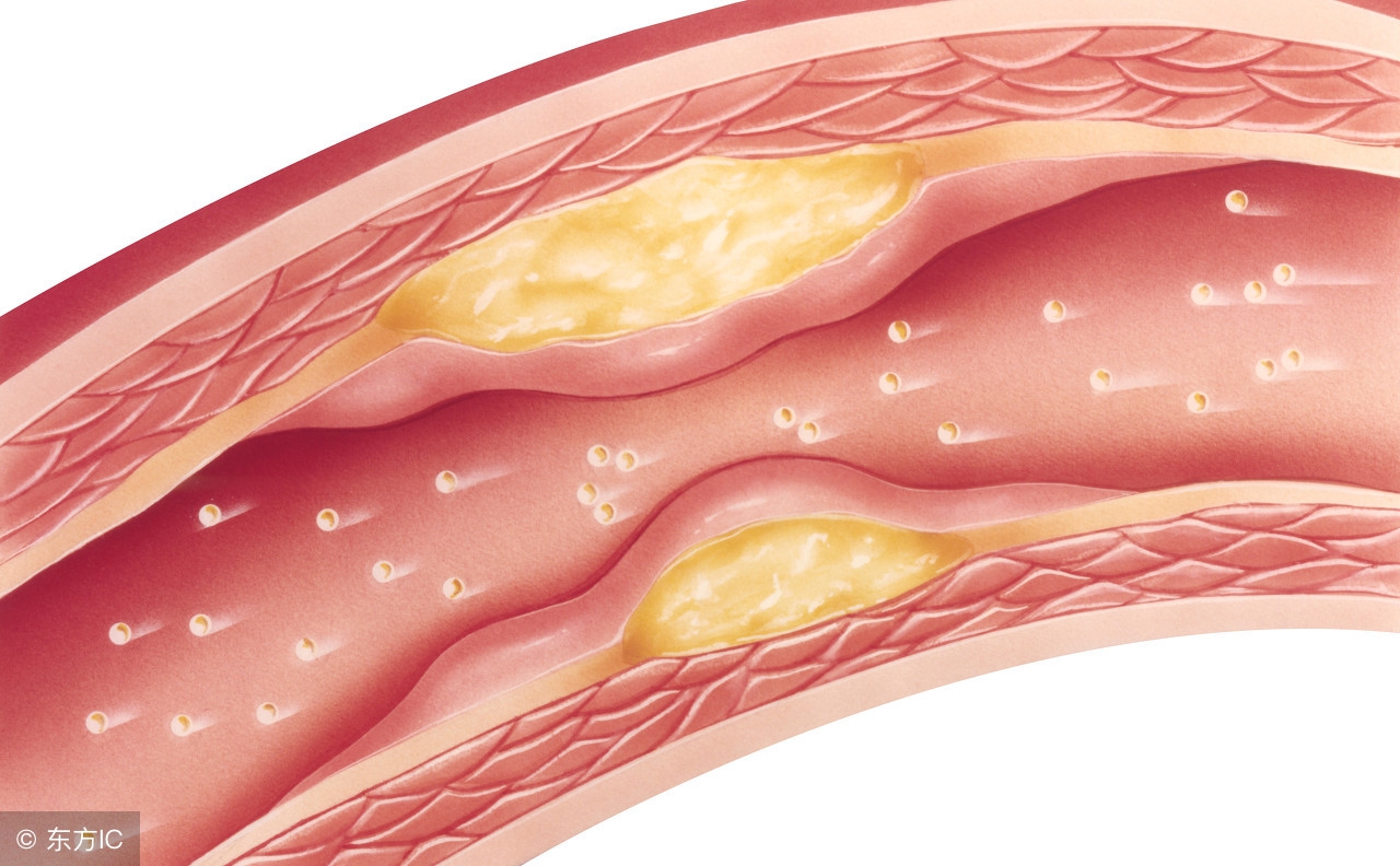 怎样预防血液斑块形成,血液里斑块怎么形成