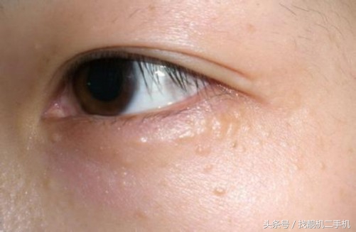 脸上的脂肪粒怎么去除妙招,脸上的脂肪粒怎么除掉