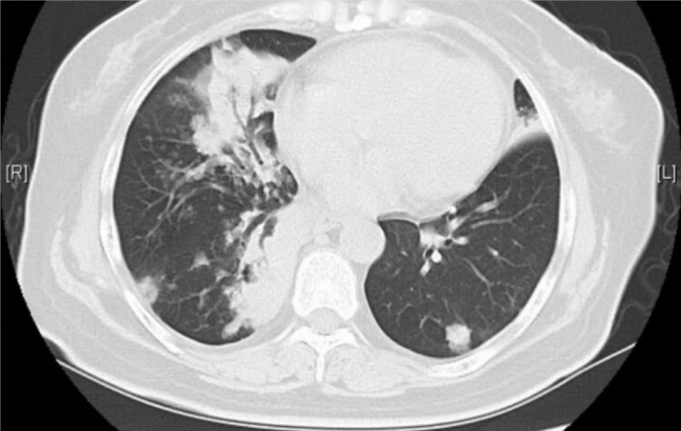 癌症晚期带病长期生存,癌症患者的生存记录