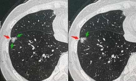 吸烟的肺癌患者放疗效果好吗,70岁肺癌放疗