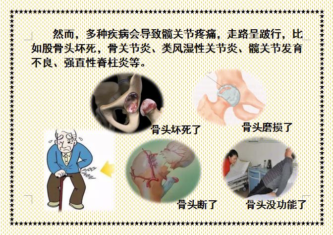 人工髋关节置换术前准备护理,人工髋关节置换术的健康宣教手册