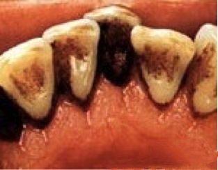 生活中常见的10大伤牙习惯，你中招了几个？