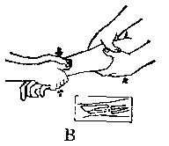 中医骨折治疗原则,中医骨伤整复术