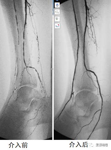 脚痛膝盖冷,脚痛腿发麻是怎么回事