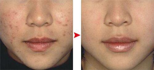 悄然流行的祛痘神器：珂玥（coco）老师的“3×1定期跟踪疗法”