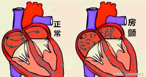 房颤使用胺碘酮治疗心率47,持续性房颤吃胺碘酮管用吗